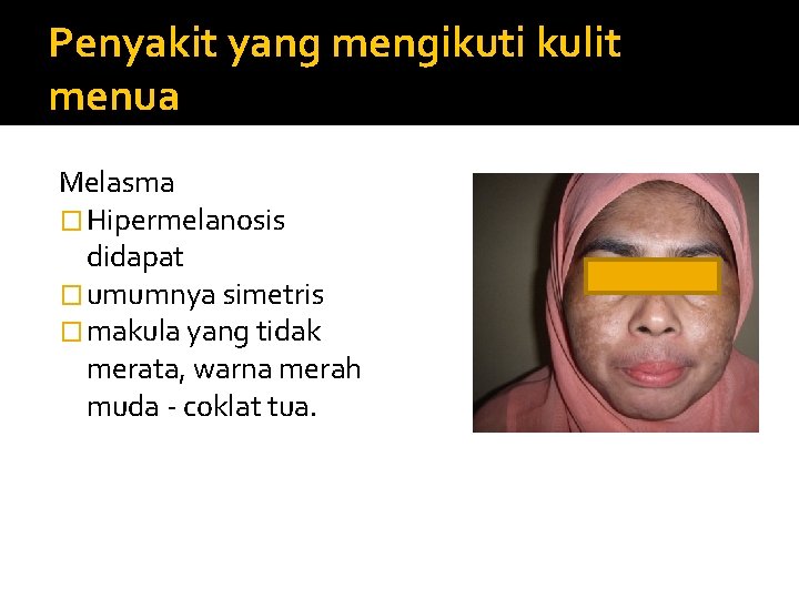 Penyakit yang mengikuti kulit menua Melasma � Hipermelanosis didapat � umumnya simetris � makula