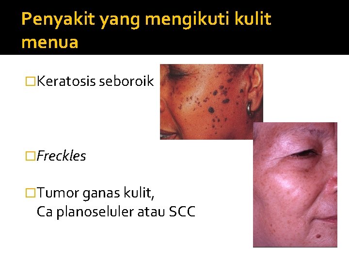 Penyakit yang mengikuti kulit menua �Keratosis seboroik �Freckles �Tumor ganas kulit, Ca planoseluler atau