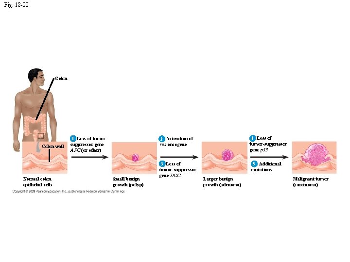 Fig. 18 -22 Colon EFFECTS OF MUTATIONS Colon wall Normal colon epithelial cells 1