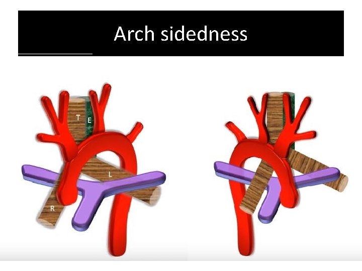 Arch sidedness Arch sidedness