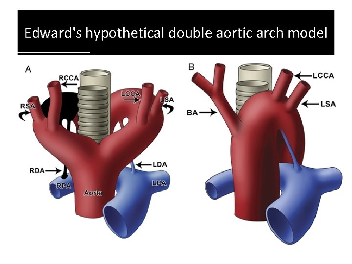 Edward's hypothetical double aortic arch model Edward's hypothetical double aortic arch model