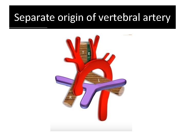 Separate origin of vertebral artery Separate origin of vertebral artery