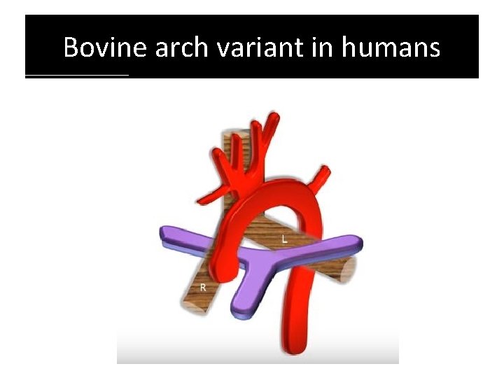 Bovine arch variant in humans Bovine arch variant in humans