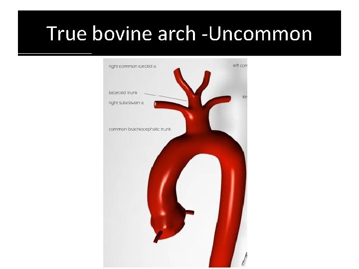 True bovine arch -Uncommon True bovine arch -Uncommon