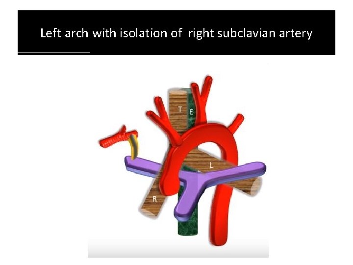 Left arch with isolation of right subclavian artery Left arch with isolation of right subclavian artery