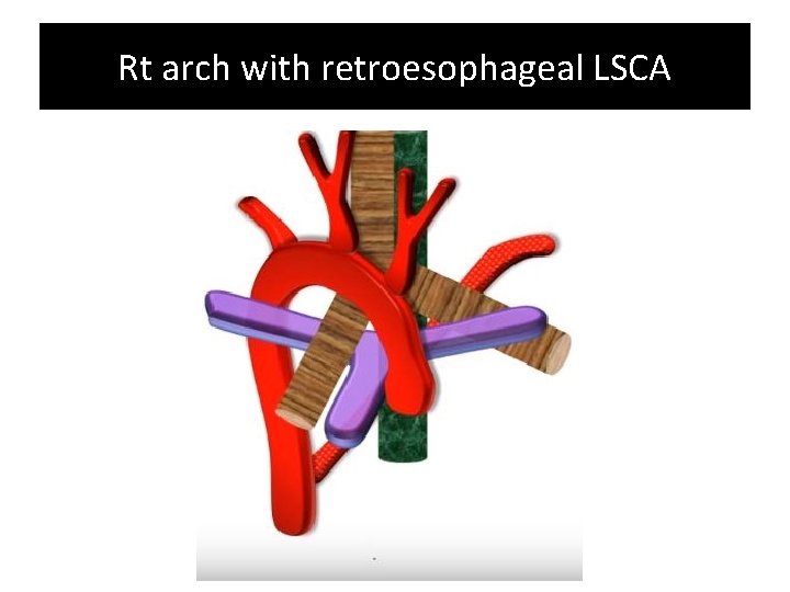 Rt arch with retroesophageal LSCA Rt arch with retroesophageal LSCA
