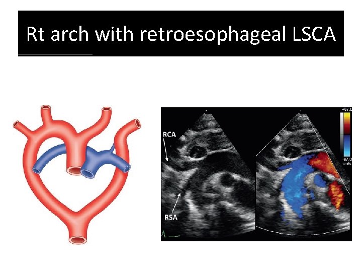 Rt arch with retroesophageal LSCA Rt arch with retroesophageal LSCA