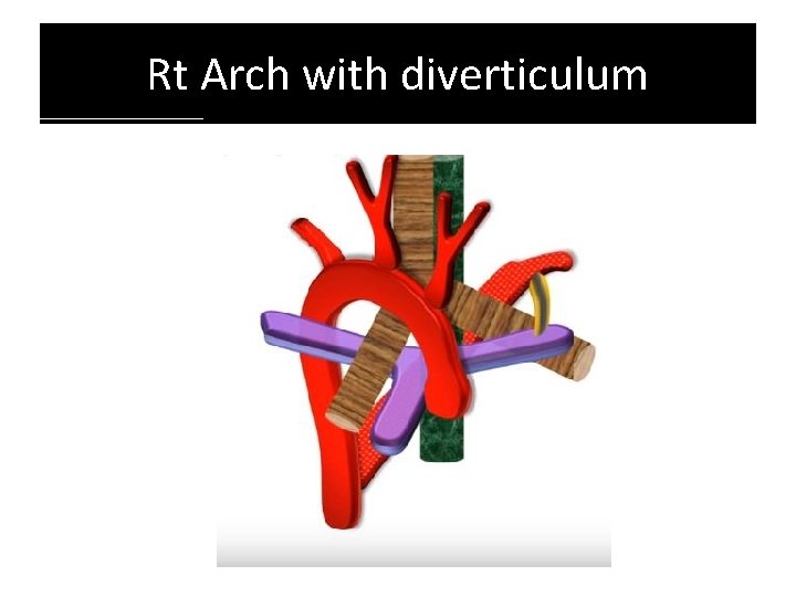 Rt Arch with diverticulum Rt Arch with diverticulum