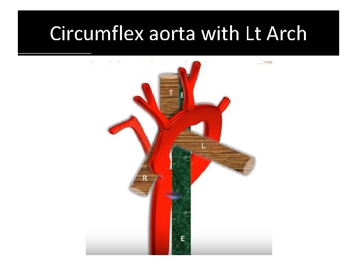 Circumflex aorta with Lt Arch Circumflex aorta with Lt Arch