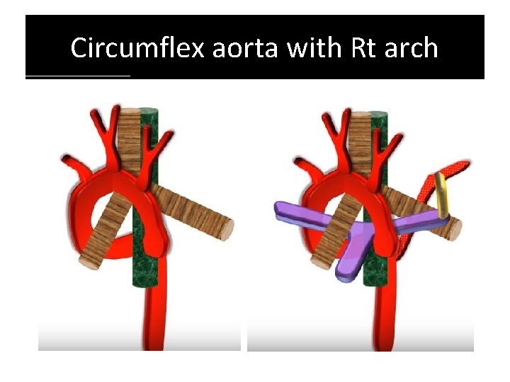 Circumflex aorta with Rt arch Circumflex aorta with Rt arch