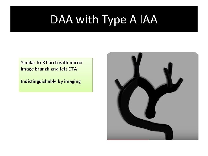 DAA with Type A IAA Similar to RT arch with mirror image branch and DAA with Type A IAA Similar to RT arch with mirror image branch and