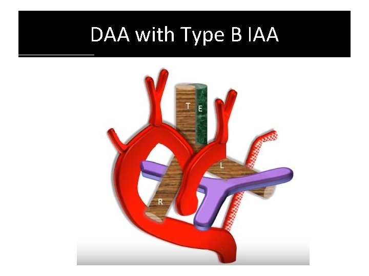 DAA with Type B IAA DAA with Type B IAA