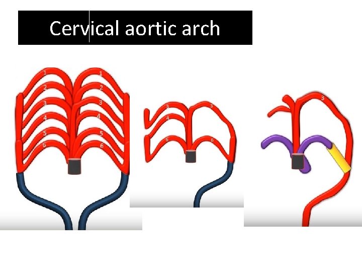 Cervical aortic arch Cervical aortic arch