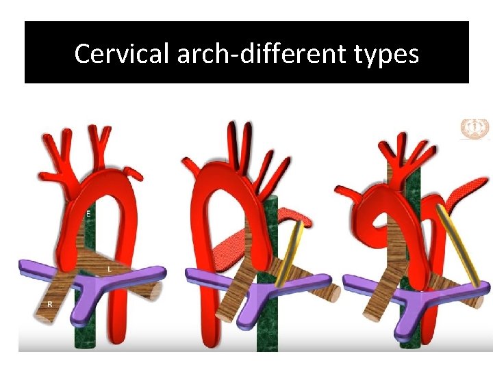 Cervical arch-different types Cervical arch-different types