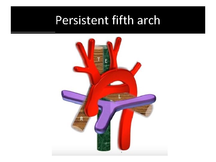 Persistent fifth arch Persistent fifth arch