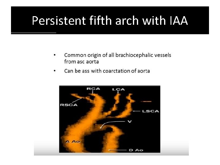 Persistent fifth arch with IAA Persistent fifth arch with IAA