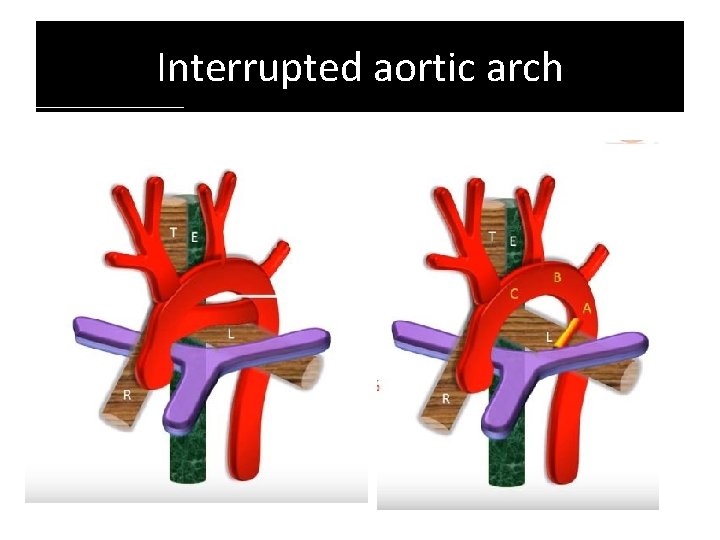 Interrupted aortic arch Interrupted aortic arch