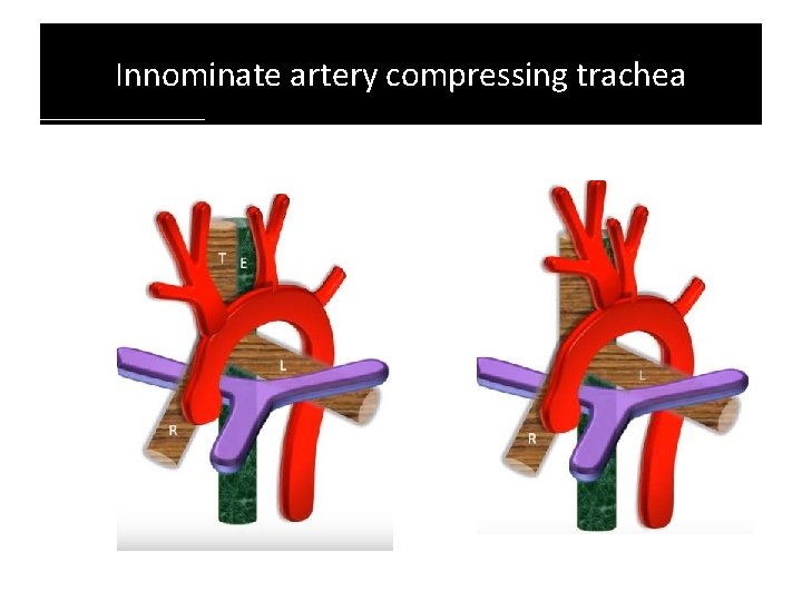 Innominate artery compressing trachea Innominate artery compressing trachea
