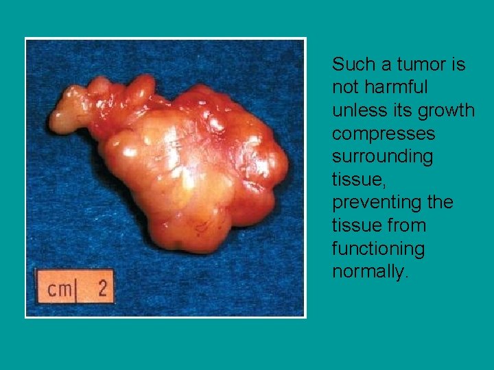 Such a tumor is not harmful unless its growth compresses surrounding tissue, preventing the