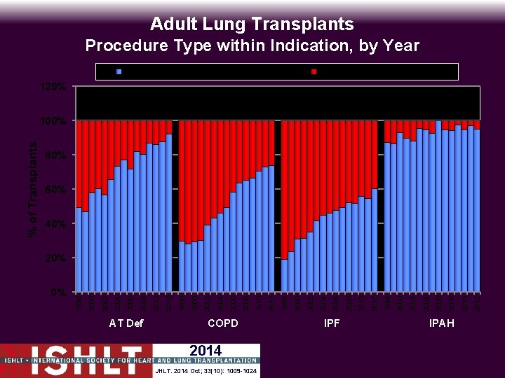 Adult Lung Transplants Procedure Type within Indication, by Year Bilateral/Double Lung Transplant Single Lung