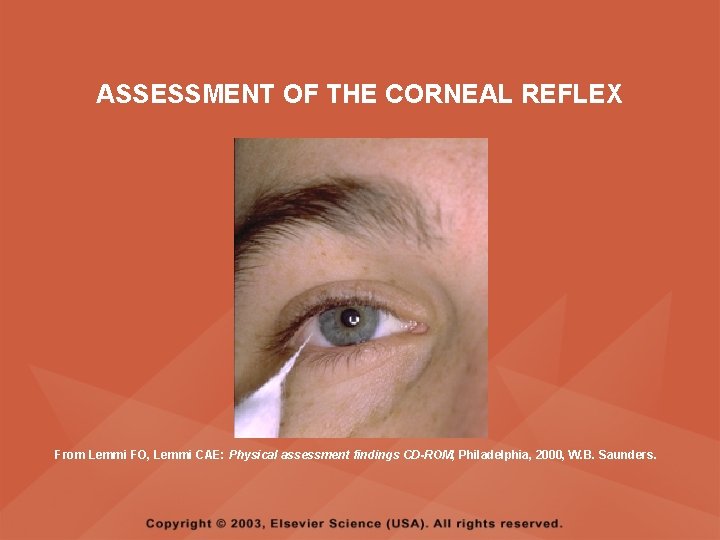ASSESSMENT OF THE CORNEAL REFLEX From Lemmi FO, Lemmi CAE: Physical assessment findings CD-ROM, ASSESSMENT OF THE CORNEAL REFLEX From Lemmi FO, Lemmi CAE: Physical assessment findings CD-ROM,