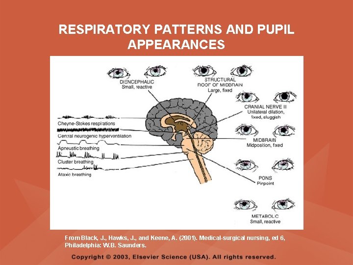 RESPIRATORY PATTERNS AND PUPIL APPEARANCES From Black, J. , Hawks, J. , and Keene, RESPIRATORY PATTERNS AND PUPIL APPEARANCES From Black, J. , Hawks, J. , and Keene,