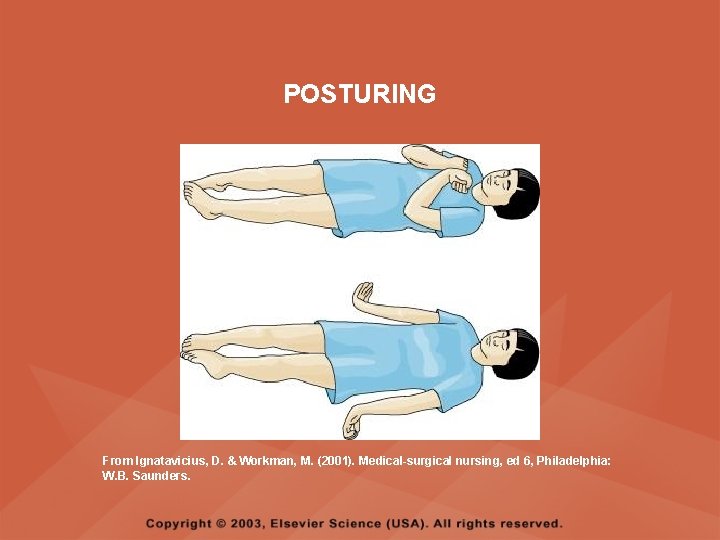 POSTURING From Ignatavicius, D. & Workman, M. (2001). Medical-surgical nursing, ed 6, Philadelphia: W. POSTURING From Ignatavicius, D. & Workman, M. (2001). Medical-surgical nursing, ed 6, Philadelphia: W.