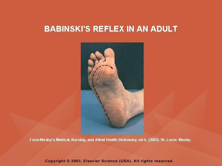 BABINSKI’S REFLEX IN AN ADULT From Mosby’s Medical, Nursing, and Allied Health Dictionary, ed BABINSKI’S REFLEX IN AN ADULT From Mosby’s Medical, Nursing, and Allied Health Dictionary, ed