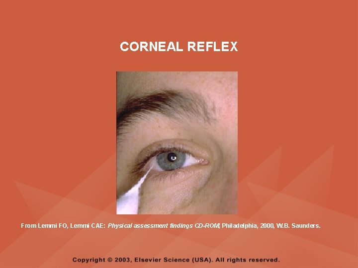 CORNEAL REFLEX From Lemmi FO, Lemmi CAE: Physical assessment findings CD-ROM, Philadelphia, 2000, W. CORNEAL REFLEX From Lemmi FO, Lemmi CAE: Physical assessment findings CD-ROM, Philadelphia, 2000, W.