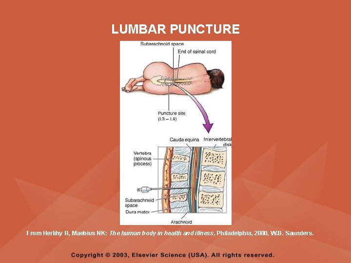 LUMBAR PUNCTURE From Herlihy B, Maebius NK: The human body in health and illness, LUMBAR PUNCTURE From Herlihy B, Maebius NK: The human body in health and illness,