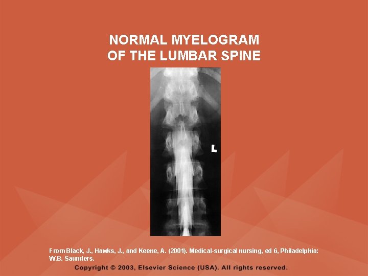 NORMAL MYELOGRAM OF THE LUMBAR SPINE From Black, J. , Hawks, J. , and NORMAL MYELOGRAM OF THE LUMBAR SPINE From Black, J. , Hawks, J. , and
