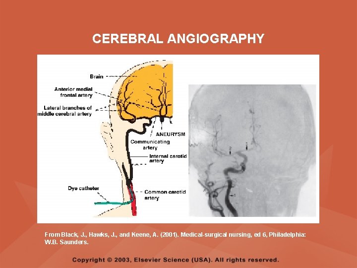 CEREBRAL ANGIOGRAPHY From Black, J. , Hawks, J. , and Keene, A. (2001). Medical-surgical CEREBRAL ANGIOGRAPHY From Black, J. , Hawks, J. , and Keene, A. (2001). Medical-surgical