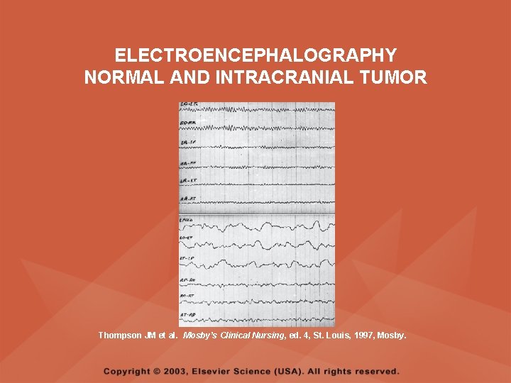 ELECTROENCEPHALOGRAPHY NORMAL AND INTRACRANIAL TUMOR Thompson JM et al. Mosby’s Clinical Nursing, ed. 4, ELECTROENCEPHALOGRAPHY NORMAL AND INTRACRANIAL TUMOR Thompson JM et al. Mosby’s Clinical Nursing, ed. 4,