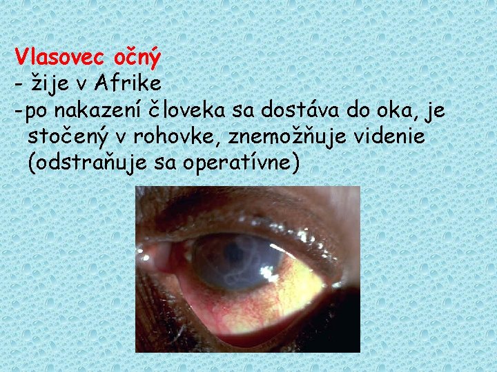 Vlasovec očný - žije v Afrike -po nakazení človeka sa dostáva do oka, je