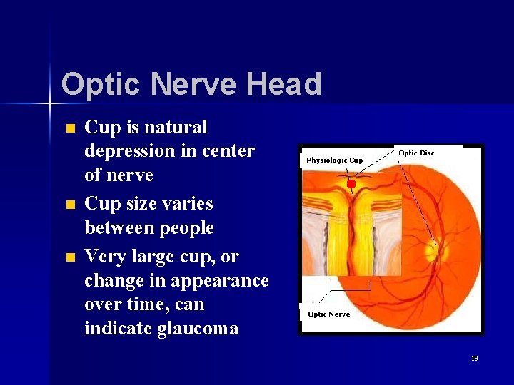 Optic Nerve Head n n n Cup is natural depression in center of nerve