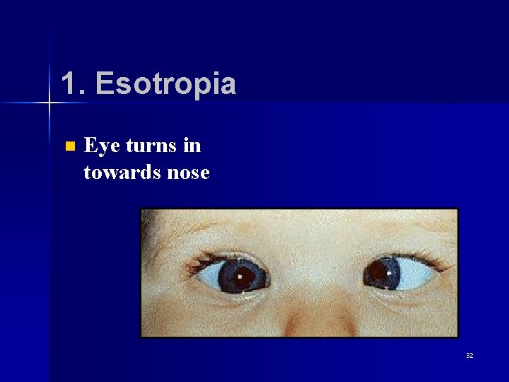 1. Esotropia n Eye turns in towards nose 32 