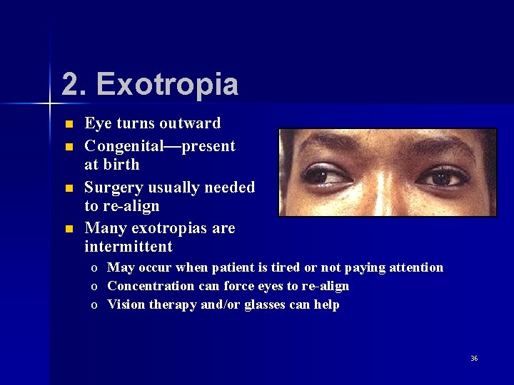 2. Exotropia n n Eye turns outward Congenital—present at birth Surgery usually needed to
