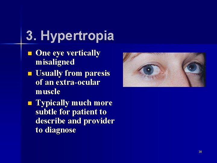 3. Hypertropia n n n One eye vertically misaligned Usually from paresis of an