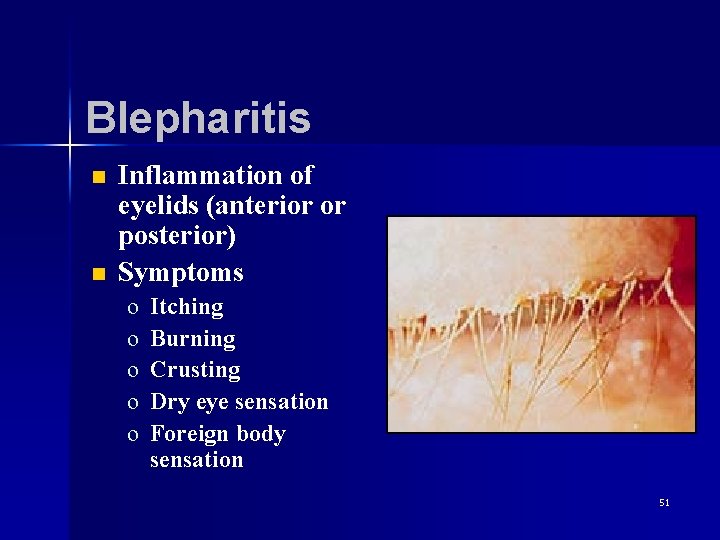 Blepharitis n n Inflammation of eyelids (anterior or posterior) Symptoms o o o Itching