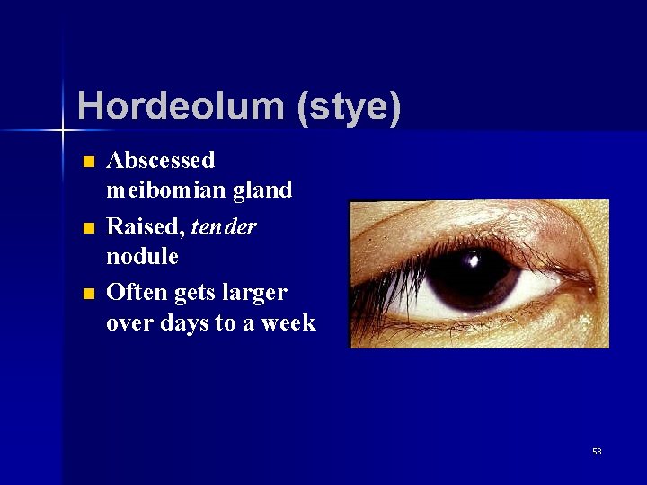 Hordeolum (stye) n n n Abscessed meibomian gland Raised, tender nodule Often gets larger