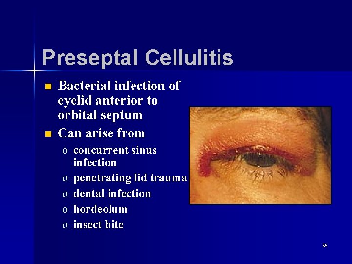 Preseptal Cellulitis n n Bacterial infection of eyelid anterior to orbital septum Can arise