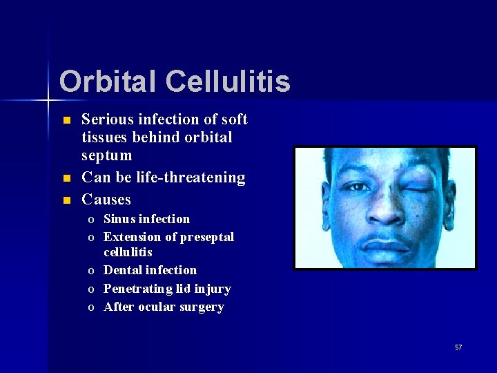 Orbital Cellulitis n n n Serious infection of soft tissues behind orbital septum Can