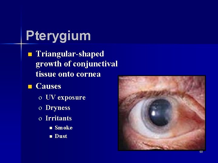 Pterygium n n Triangular-shaped growth of conjunctival tissue onto cornea Causes o UV exposure