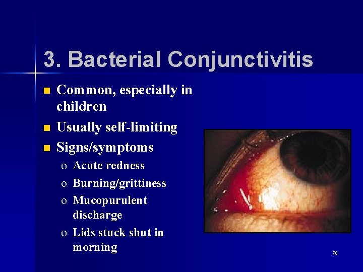 3. Bacterial Conjunctivitis n n n Common, especially in children Usually self-limiting Signs/symptoms o