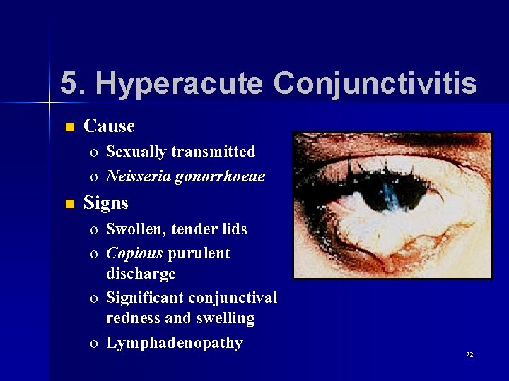 5. Hyperacute Conjunctivitis n Cause o Sexually transmitted o Neisseria gonorrhoeae n Signs o