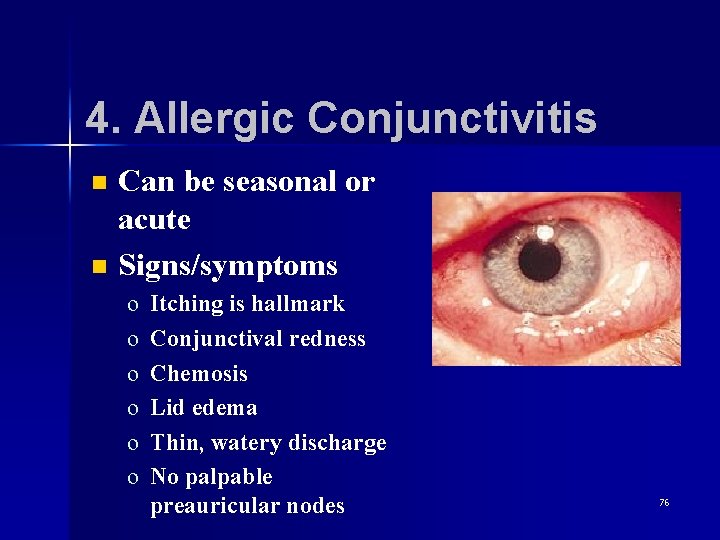 4. Allergic Conjunctivitis n n Can be seasonal or acute Signs/symptoms o o o