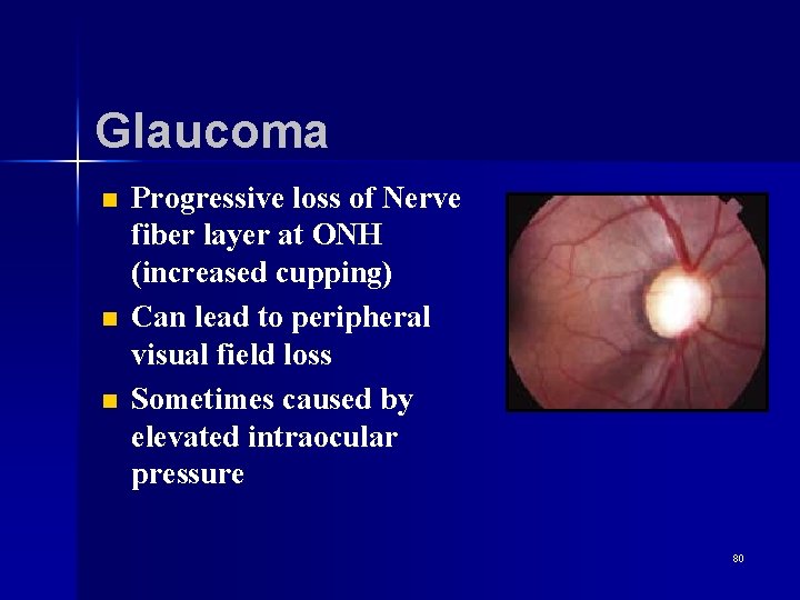 Glaucoma n n n Progressive loss of Nerve fiber layer at ONH (increased cupping)