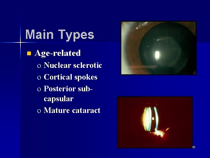 Main Types n Age-related o Nuclear sclerotic o Cortical spokes o Posterior subcapsular o