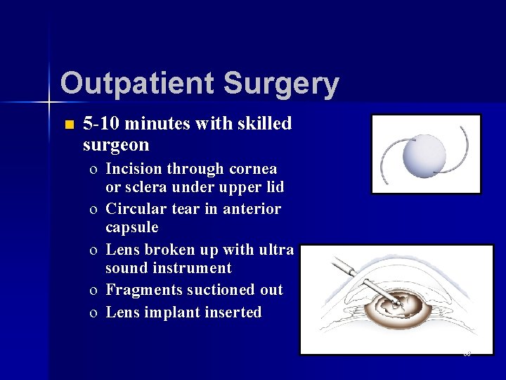 Outpatient Surgery n 5 -10 minutes with skilled surgeon o Incision through cornea or