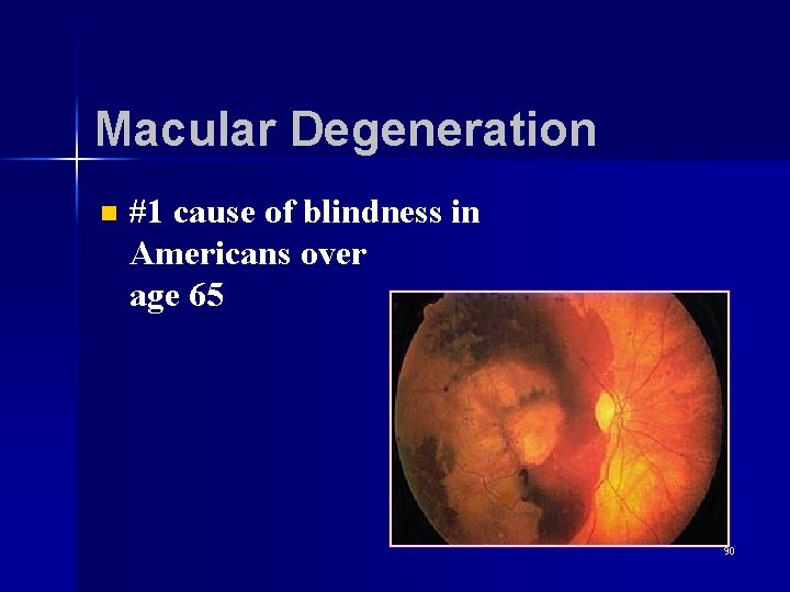 Macular Degeneration n #1 cause of blindness in Americans over age 65 90 